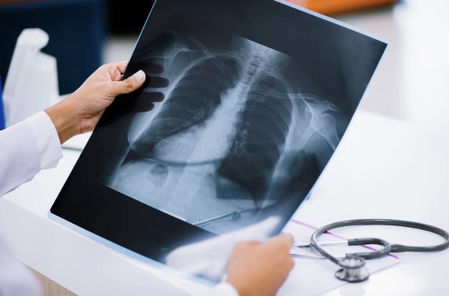 lung cancer screening